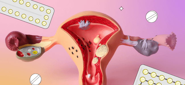 PCOS Is Now PMOS: What It Means for Birth Control, Periods, and Fertility